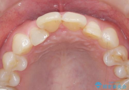 インビザラインで行う前歯のみの部分矯正の治療前