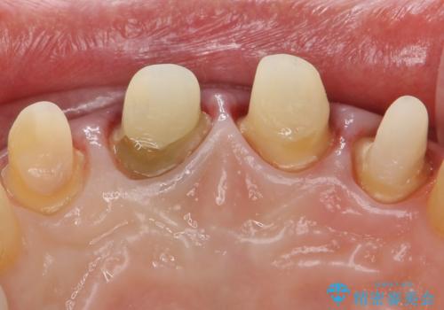 自然な前歯にしたい ジルコニアクラウンでの修復の治療中