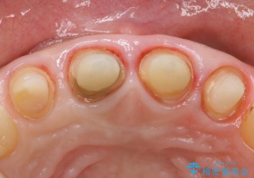 自然な前歯にしたい ジルコニアクラウンでの修復の治療中