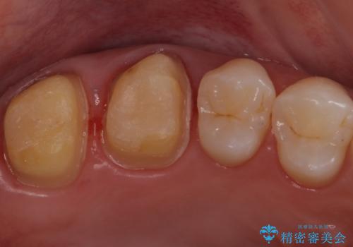 銀歯を白くしたいの治療中