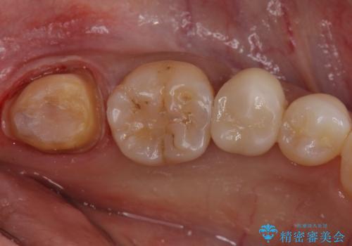 産後の虫歯治療 セラミッククラウンでの治療の治療中