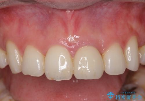 変色してきた前歯をセラミック治療の治療後