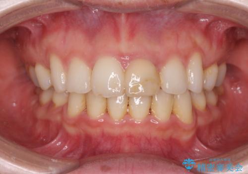 変色してきた前歯をセラミック治療の治療前