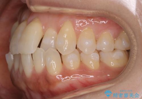 【非抜歯】短期間で実現する前歯の反対咬合治療の治療中