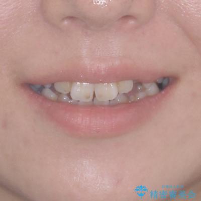 インビザラインが続けられない 装置変更して抜歯矯正の治療前(顔貌)