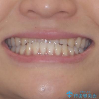 前歯のクロスバイトを治したい　ワイヤー装置による矯正治療の治療前（顔貌）