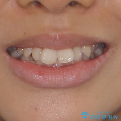 八重歯と乱れた咬み合わせを改善 ワイヤー装置での抜歯矯正の治療前(顔貌)