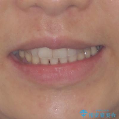 正中のズレと飛び出した前歯を改善 メタルブラケットでの抜歯矯正の治療前(顔貌)