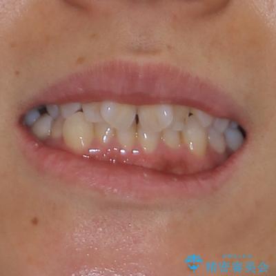 既に2本が抜歯されている歯列 咬み合わせのズレを改善する抜歯矯正の治療前(顔貌)