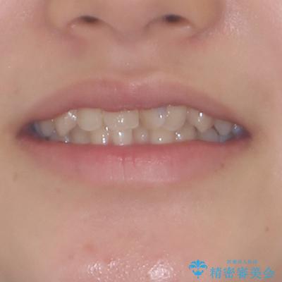 深い咬み合わせとデコボコの歯列をワイヤー矯正で改善の治療前（顔貌）