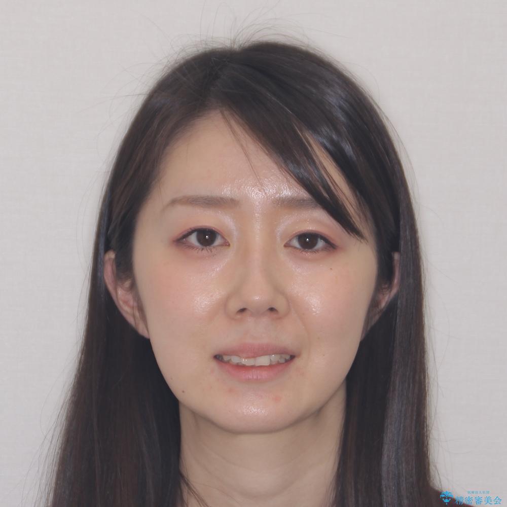 【モニター】前歯のデコボコをインビザラインで改善の治療前(顔貌)