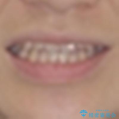 前歯のクロスバイト インビザラインによる矯正治療の治療前(顔貌)