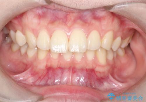 【ワイヤー矯正】前歯の真ん中を合わせたい。の症例 治療前