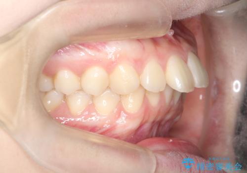 【ワイヤー矯正】前歯の真ん中を合わせたい。の治療前