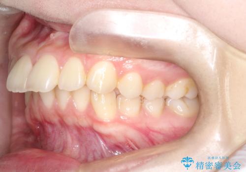 【ワイヤー矯正】前歯の真ん中を合わせたい。の治療前