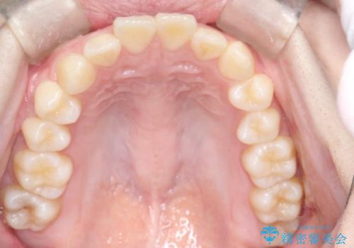 【ワイヤー矯正】前歯の真ん中を合わせたい。の治療前