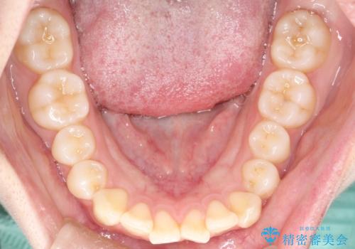 【ワイヤー矯正】前歯の真ん中を合わせたい。の治療前