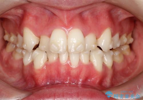 【抜歯インビザ】前歯の凸凹をなおしたいの治療中