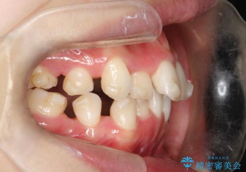 【抜歯インビザ】前歯の凸凹をなおしたいの治療中