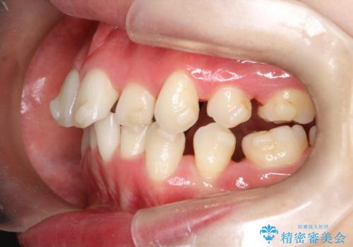 【抜歯インビザ】前歯の凸凹をなおしたいの治療中