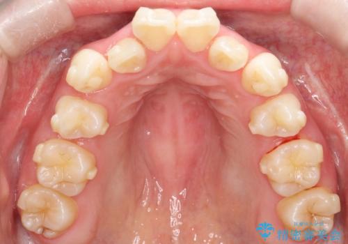 【抜歯インビザ】前歯の凸凹をなおしたいの治療中