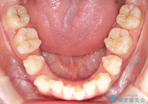 【抜歯インビザ】前歯の凸凹をなおしたいの治療中
