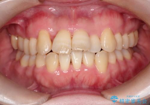 【インビザライン】ずれた前歯の噛み合わせをなおしたいの治療前