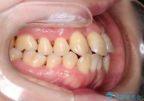 【インビザライン】ずれた前歯の噛み合わせをなおしたいの治療前