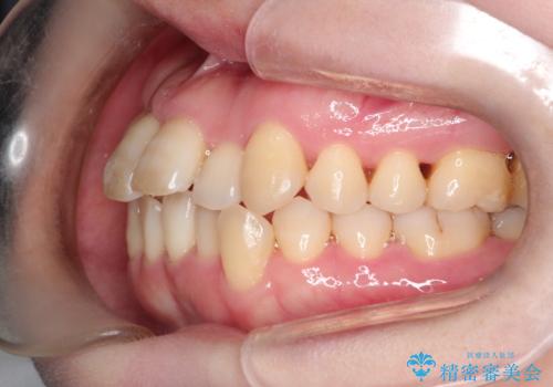 【インビザライン】ずれた前歯の噛み合わせをなおしたいの治療前