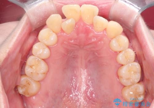 【インビザライン】ずれた前歯の噛み合わせをなおしたいの治療前