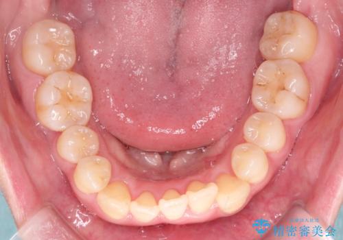 【インビザライン】ずれた前歯の噛み合わせをなおしたいの治療前