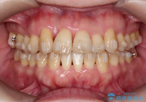 【インビザライン】ずれた前歯の噛み合わせをなおしたいの治療中