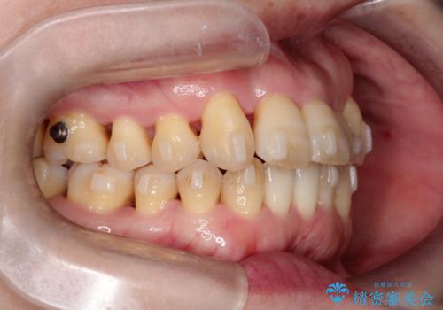 【インビザライン】ずれた前歯の噛み合わせをなおしたいの治療中