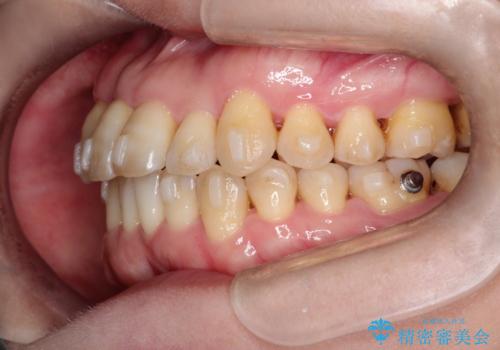 【インビザライン】ずれた前歯の噛み合わせをなおしたいの治療中