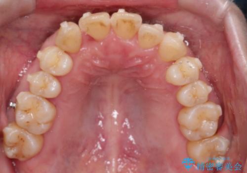 【インビザライン】ずれた前歯の噛み合わせをなおしたいの治療中
