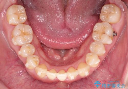 【インビザライン】ずれた前歯の噛み合わせをなおしたいの治療中