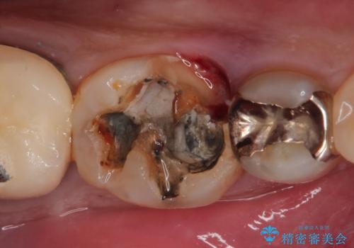 【インプラント】食事中に歯が割れた! かなり深いところまで歯が割れていたの治療中