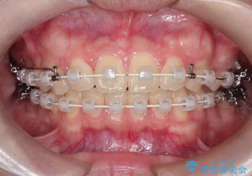 【ワイヤー矯正】前歯の真ん中を合わせたい。の治療中