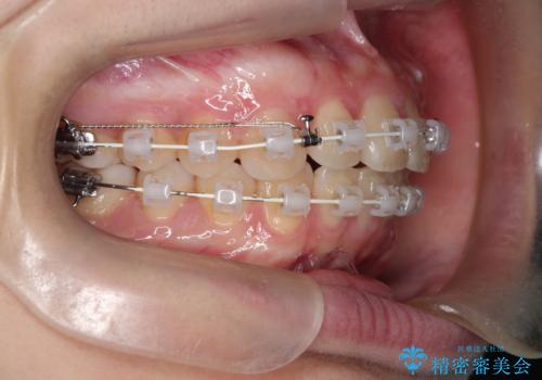 【ワイヤー矯正】前歯の真ん中を合わせたい。の治療中