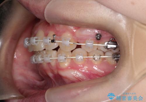 【ワイヤー矯正】前歯の真ん中を合わせたい。の治療中