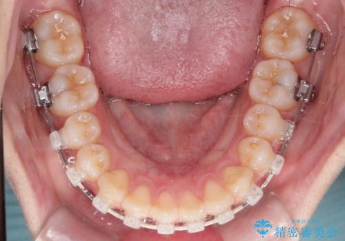 【ワイヤー矯正】前歯の真ん中を合わせたい。の治療中