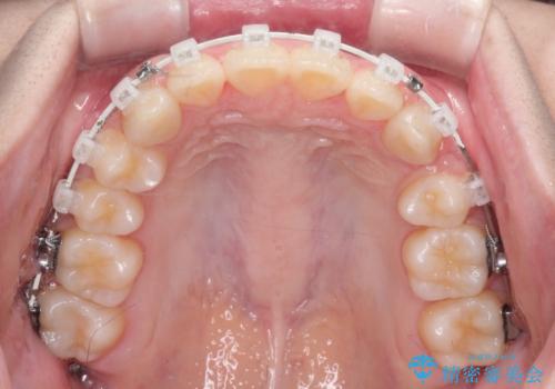 【ワイヤー矯正】前歯の真ん中を合わせたい。の治療中