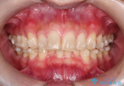 【インビザライン】前歯の凸凹を治したいの治療中