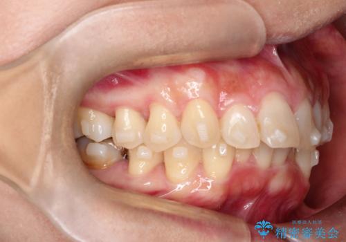 【インビザライン】前歯の凸凹を治したいの治療中