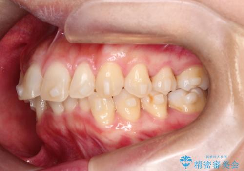 【インビザライン】前歯の凸凹を治したいの治療中