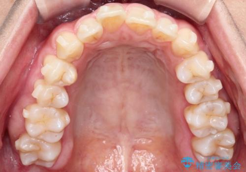 【インビザライン】前歯の凸凹を治したいの治療中