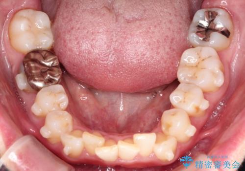 【インビザライン】前歯の凸凹を治したいの治療中