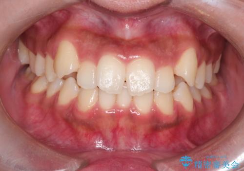 【インビザライン】笑ったときに目立つ八重歯をなおしたいの治療前