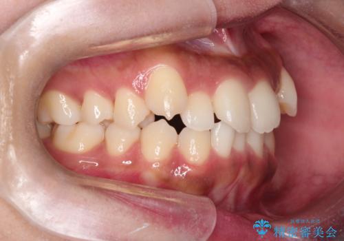 【インビザライン】笑ったときに目立つ八重歯をなおしたいの治療前