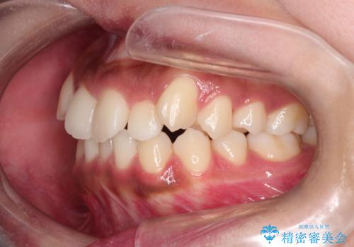 【インビザライン】笑ったときに目立つ八重歯をなおしたいの治療前